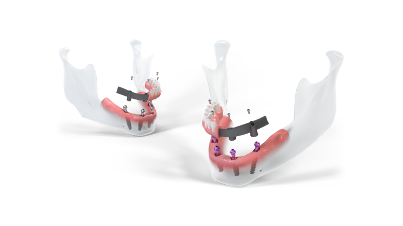 Giải pháp Straumann® ProArch 4