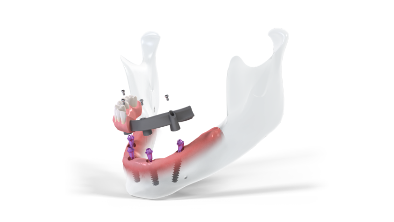 Giải pháp Straumann® ProArch