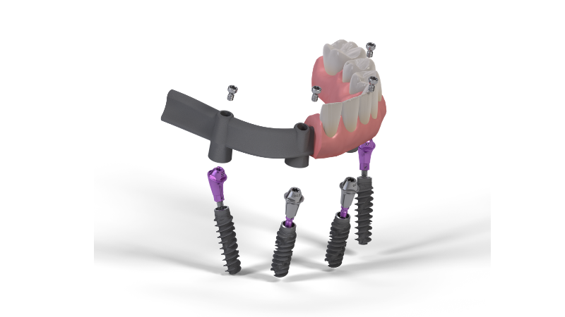 Giải pháp Straumann® ProArch 3