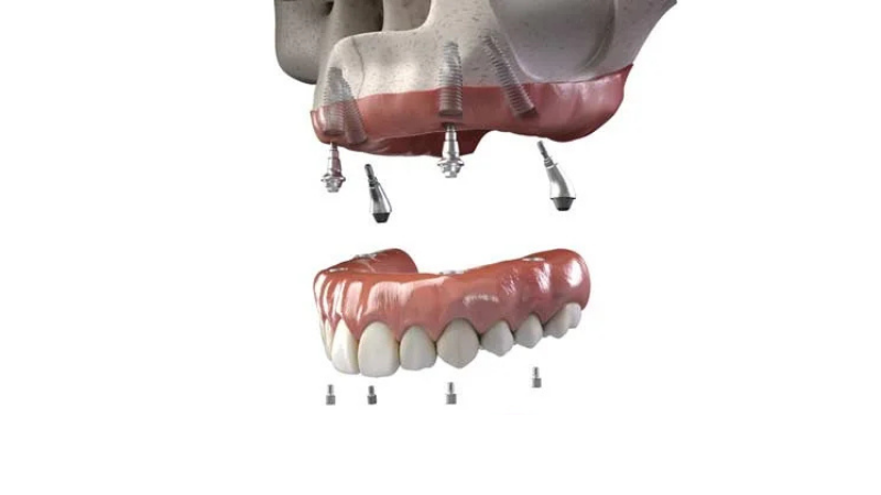 Neodent® NeoArch® 4