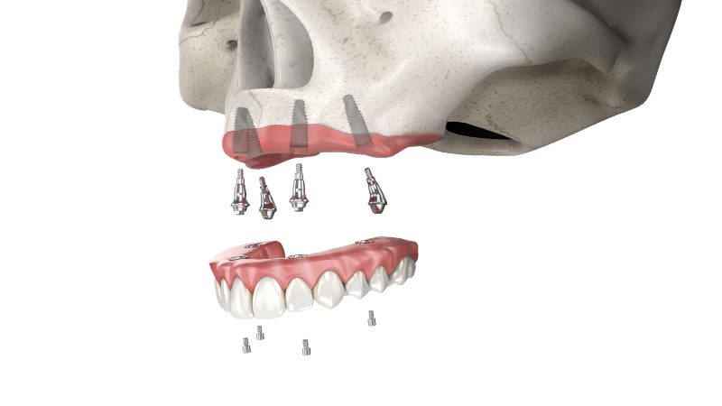 Neodent® NeoArch® 3